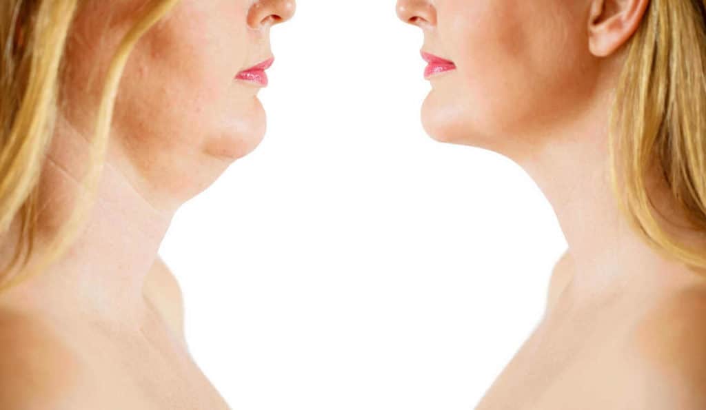 Double Chin treatment North Kensington before and after results
