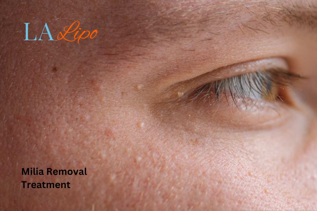 Cryopen Milia Removal: Is It the Easiest and Safest Option North Kensington?