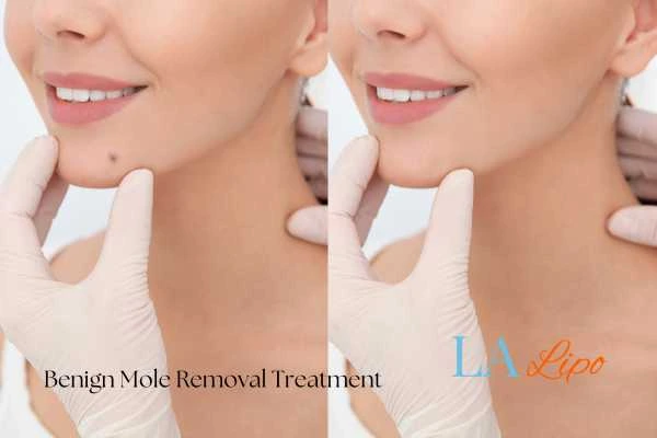 Before-and-after results following benign mole-removal treatment North Kensington