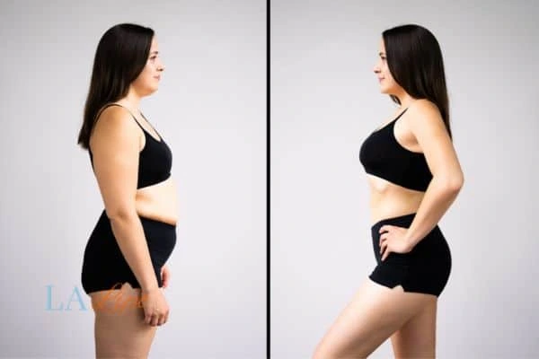 image of woman before and after results of LA-EMS Body Sculpting North Kensington to help treat Diastasis recti