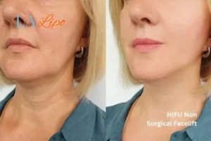 hi-fu for wrinkles North Kensington before and after results