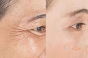 Before and after results of woman - HI-fu wrinkles reduction treatment North Kensington