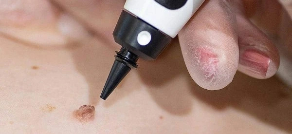 skin tag removal using cryopen North Kensington