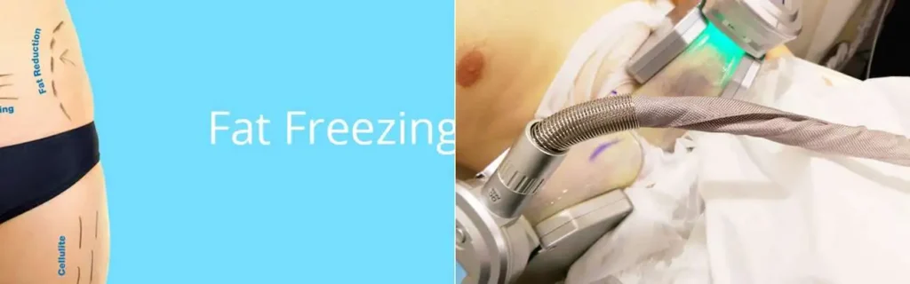 Fat freezing North Kensington on multiple areas of the body