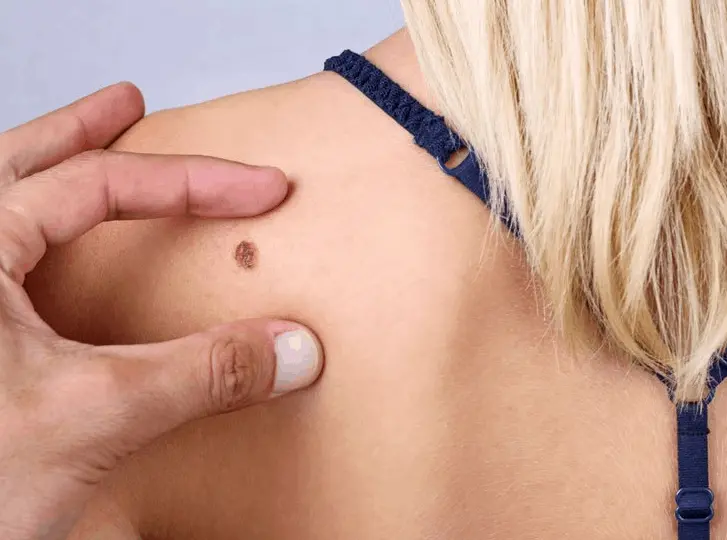 woman having mole removal North Kensington consultation before treatment.