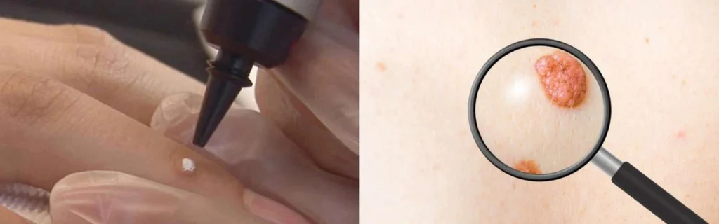 CryoPen practitioner North Kensington assessing a benign mole before treatment