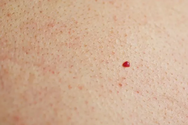 close up of a cherry angioma North Kensington