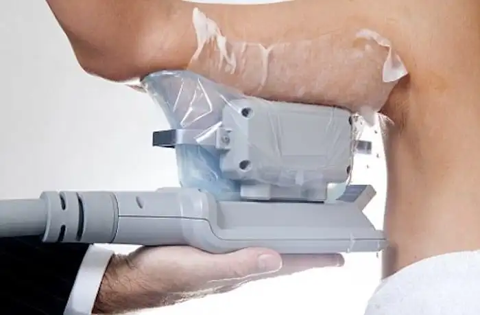 Picture of fat freezing North Kensington on the upper arms.
