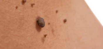 image of a skin tag North Kensington