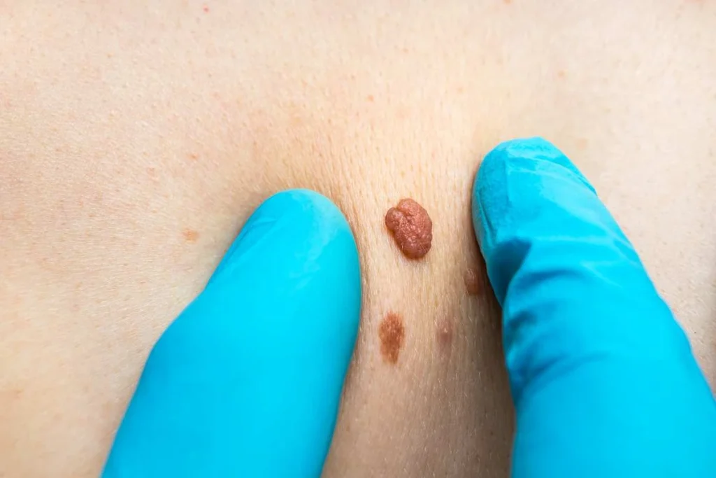 Consultant examining a skin tag North Kensington
