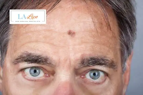 Solar Lentigo Removal North Kensington image of man with mark on his forehead