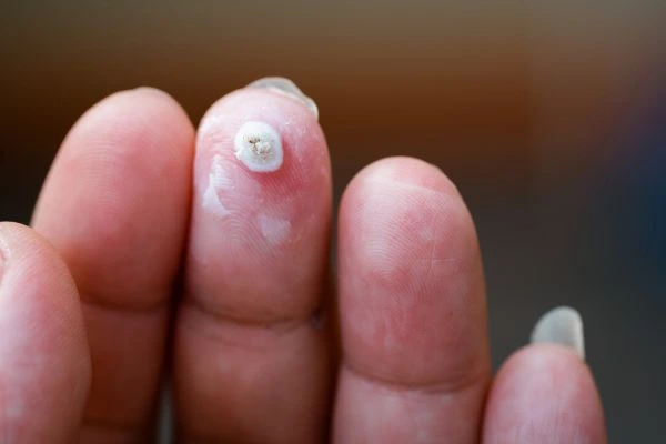 wart on person finger - cryotherapy to treat from LA LIPO North Kensington