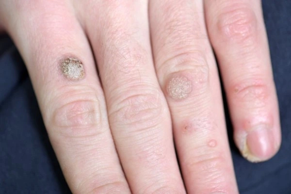 photo of warts on person hand - see wart removal North Kensington from LA LIPO