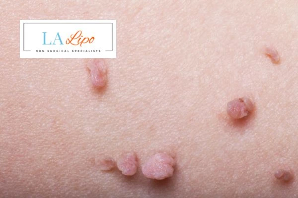 Does cryopen skin tag removal North Kensington hurt? Find out now call our team today!