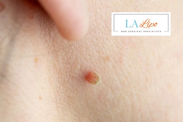 Book skin tag removal North Kensington today speak to our team now!