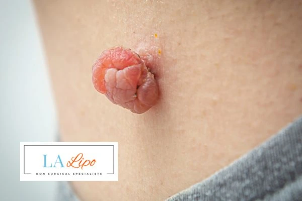 Interested in skin tag removal North Kensington? Concerned about the pain? Find out more today!