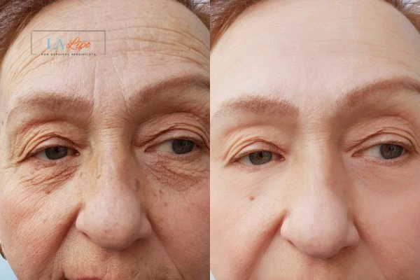 The powerful benefits of Morpheus8 Treatment North Kensington - Call Our team today!
