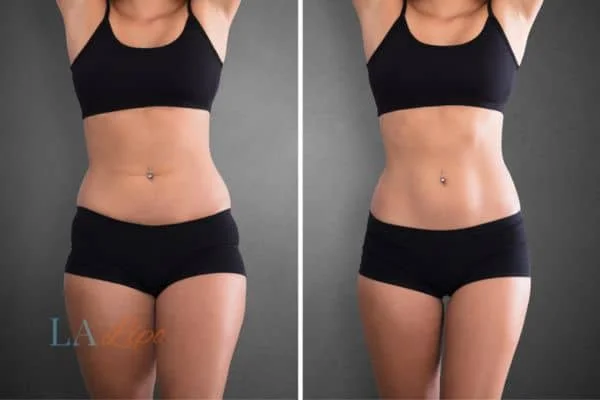 before and after results of non-surgical treatment to help a woman's body image and mental health North Kensington