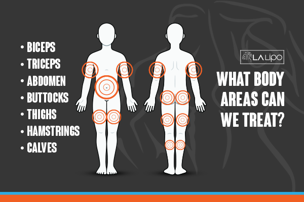 Diagram to show areas you can have LA-EMS Body Sculpting Treatment North Kensington