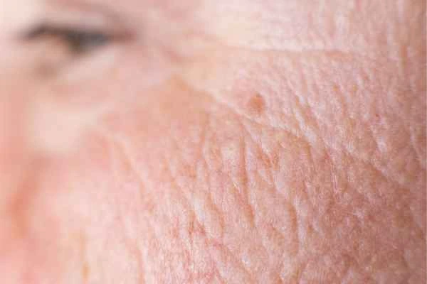 close up picture of a woman's face showing an age spot North Kensington
