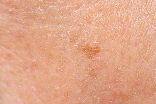 close up picture of age spots North Kensington