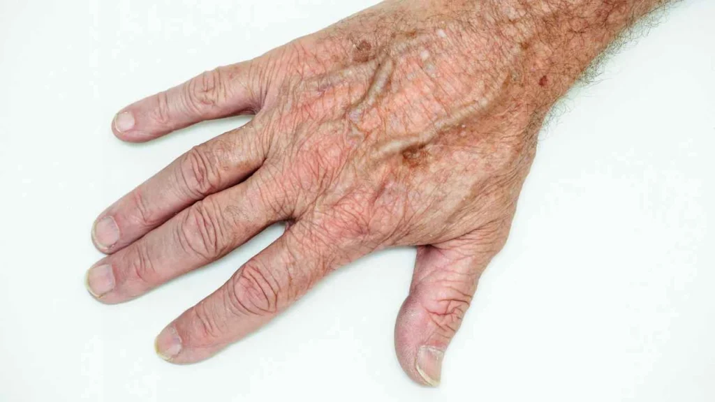 Male hand showing age spot North Kensington