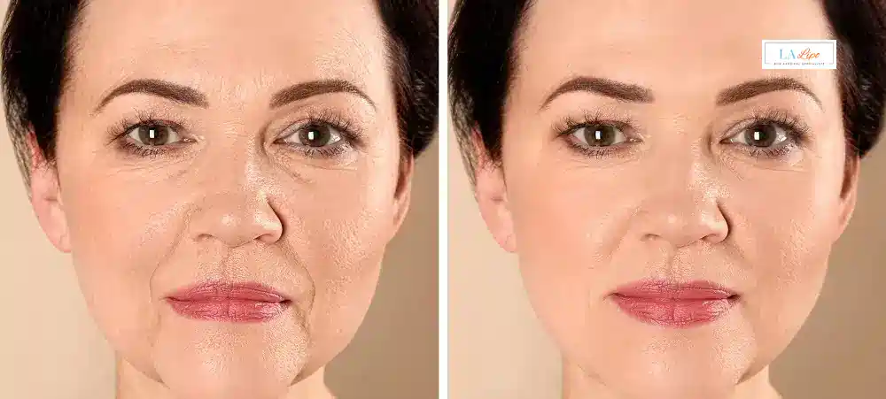 How Long Does It Take to See Results and How Long Do They Last North Kensington?