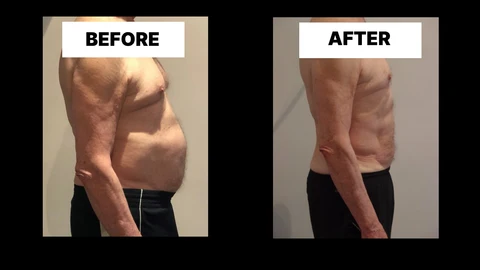 What Symptoms Can Diastasis Recti Cause in Men? Weak Core, Back Pain and Poor Posture North Kensington